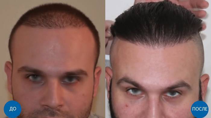Пересадка волос в Турции бесшовным методом FUE: основные аспекты - sovetnika.net - Турция