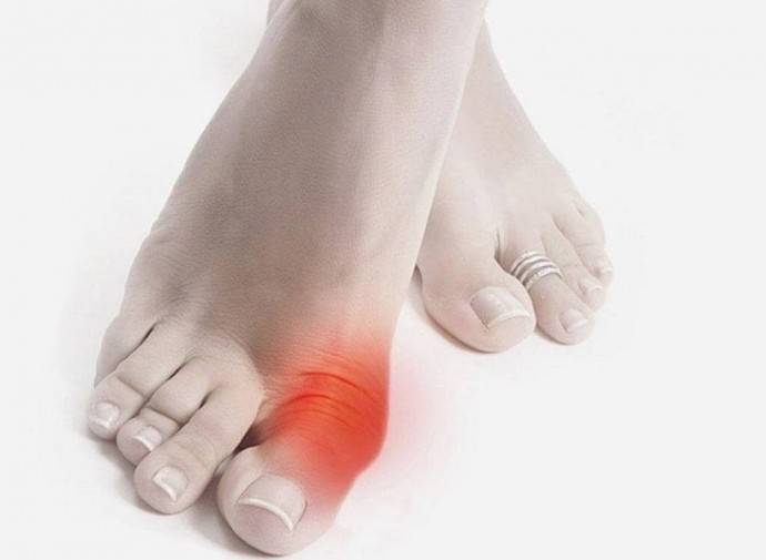 ​Профилактическое лечение подагры (косточек на ногах) с помощью обычных продуктов - polsov.com
