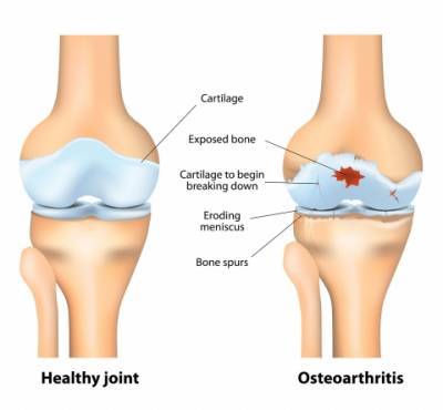 Остеоартроз суставов — что это такое и как лечить? - epochtimes.com.ua