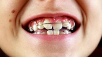 Особенности прикуса у детей: как исправить прикус ортодонтическими пластинами отвечает детский ортодонт стоматологии «Улыбнись» - 1001sovet.com - Москва