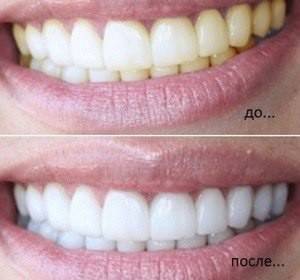 ​Натуральное отбеливание зубов - polsov.com
