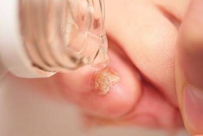 ​Профилактическое лечение грибка ногтей - polsov.com