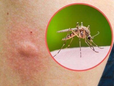​Как легко снять зуд от укусов комаров - polsov.com