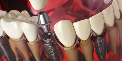 Имплантация All-on-4 при полном отсутствии зубов: альтернатива протезам - nashsovetik.ru