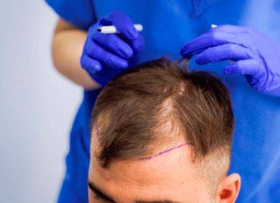 Руководство по диагностике типов алопеции - shkolazhizni.ru