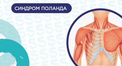 Синдром Поланда: причины, симптомы и современные методы лечения - nashsovetik.ru