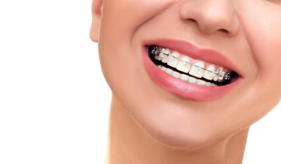 Вестибулярные брекеты: особенности, показания и результаты лечения - nashsovetik.ru