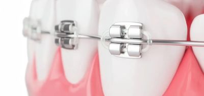 Лигатурные брекеты: что это такое и кому они подходят - nashsovetik.ru - республика Коми